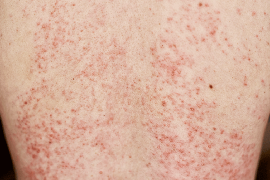 Skin Allergy