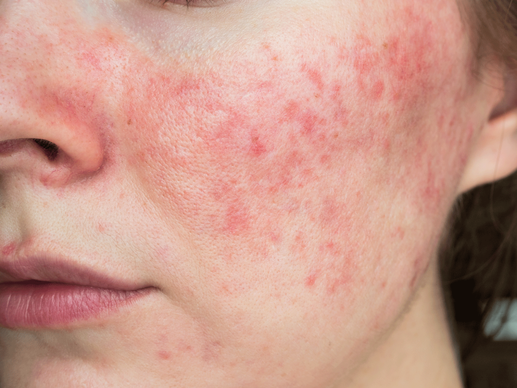 Rosacea Image